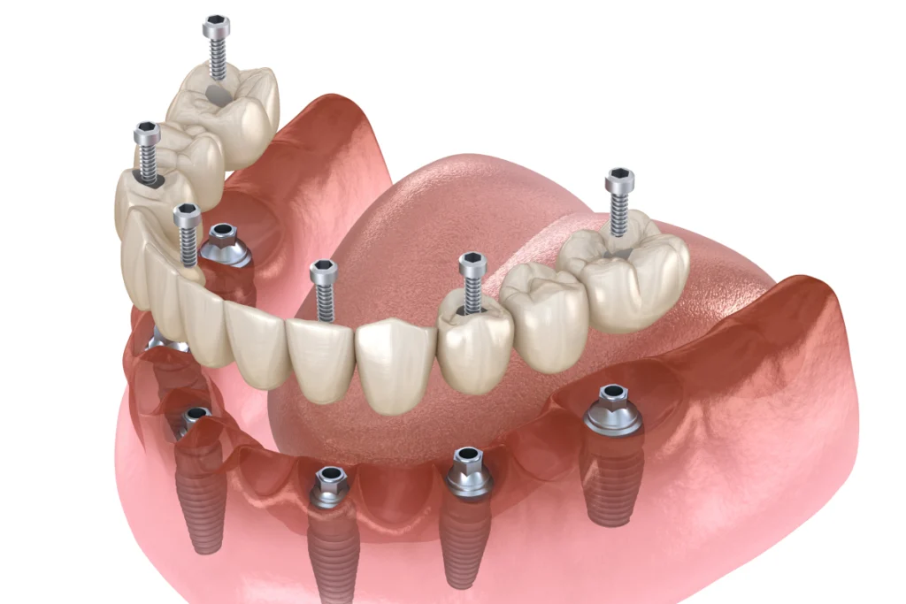 Implant dentaire complet dentier, cabinet dentaire du Dr Kalfon Journo à Sarcelles