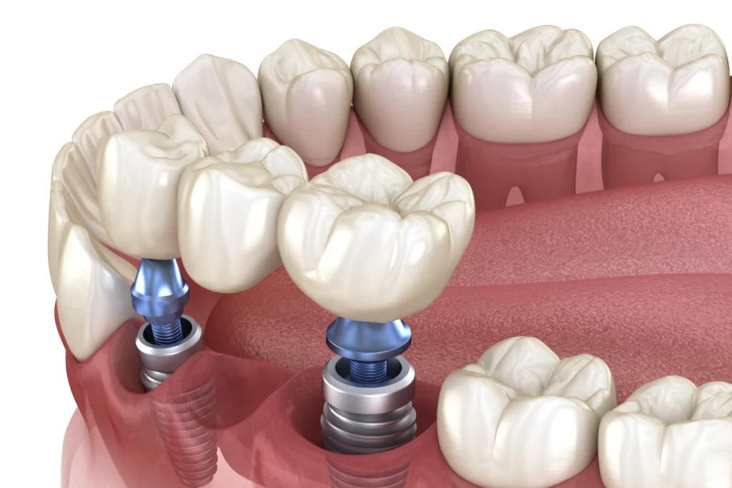 Couronne et bridge sur implants dentaires